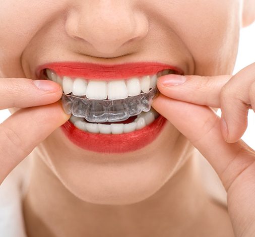 Алайнери Invisalign